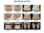 RF 360 Cryolipolysis Slimming Machine Non Invasive Cavitation ISO90 Approval