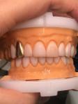 0.3-0.5mm Thick Natural Porcelain Emax Veneers High Strength Long Lasting For