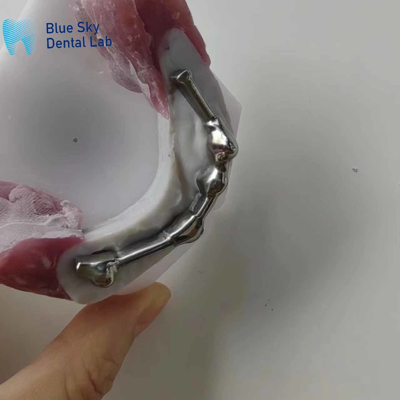 Full Mouth Milled Titanium Bar Dental Locator Denture Attachments