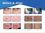 CE approved effective red facial veins removal machine for beauty salon or home