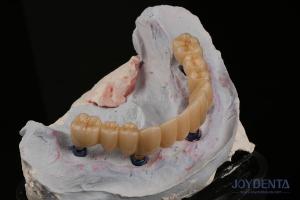 Wholesale Dental Restorations Multiple Teeth Implant Endosseous Replace Two Front Teeth from china suppliers