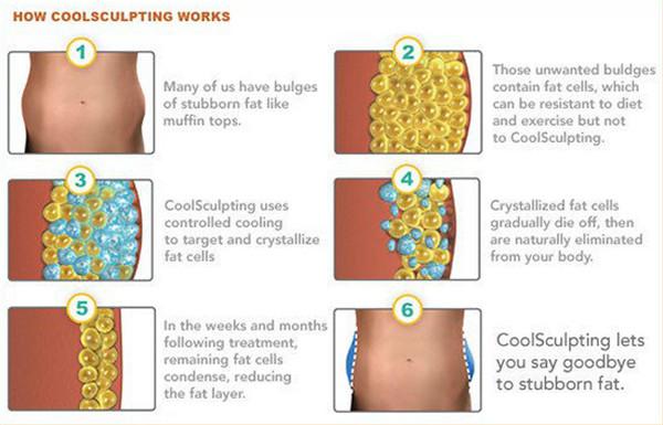 CE / FDA approved 5 treatment handles OEM/ODM Cryo + RF + Cavitation cryolipolys