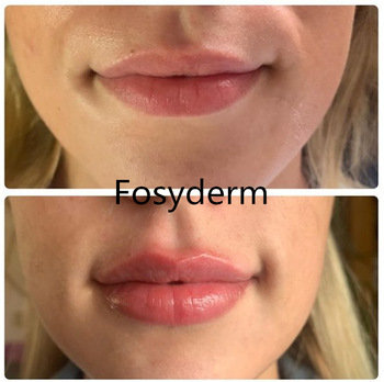 Anti Wrinkle Dermal Filler Hyaluronic Acid Facial Filler Injection 2ml Deep