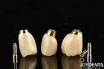 High Durability White Finish Implant Crown And Bridge With Accurate Fit