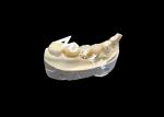 High-Hardness Aesthetic Zirconia Dental Crown with Translucency and Chipping