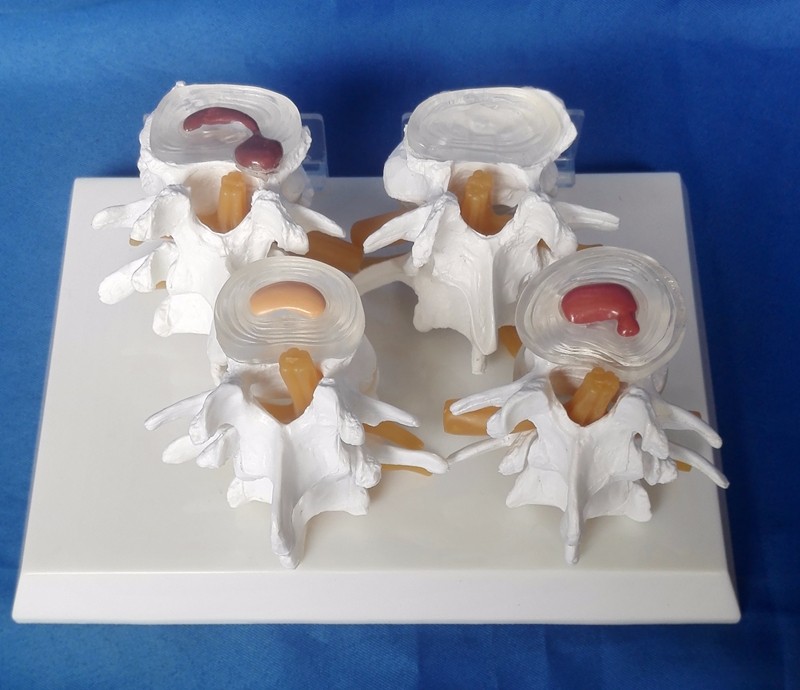 Vertebrae Diseased 4 Stage PVC Human Lumbar Spine Anatomy Model