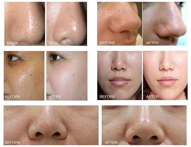 Ice Hammer Face Lift Blackhead Removal Hydro Facial Machines