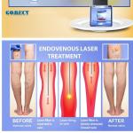 980nm 1470nm Endolift Laser Machine EVLT EVLA Endovenous Vein Laser Ablation For