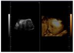 4 D 15 Inch LED Diagnostic Color Doppler Ultrasound Scanner With 2 Probe