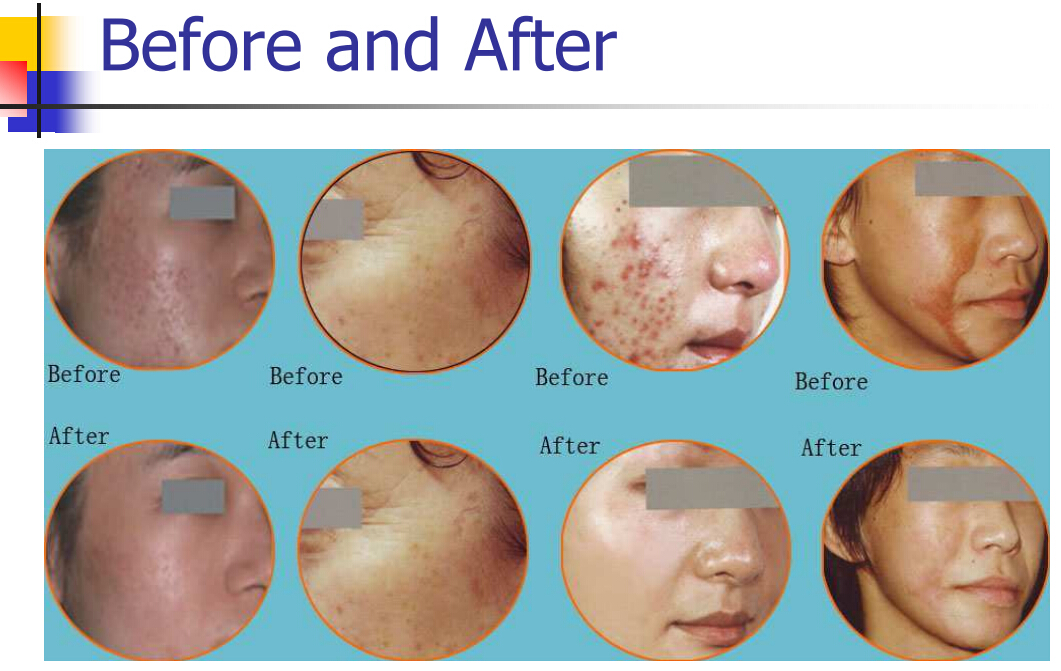 Fractional CO2 Laser Germany Standard vaginal tightening treatment laser