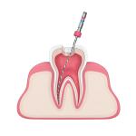 NITY Alloy Endodontic Super Elastic F3 Dental Endo Files