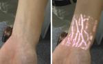 Medical Professional Infrared Vein Viewer Transilluminator Find Veins For