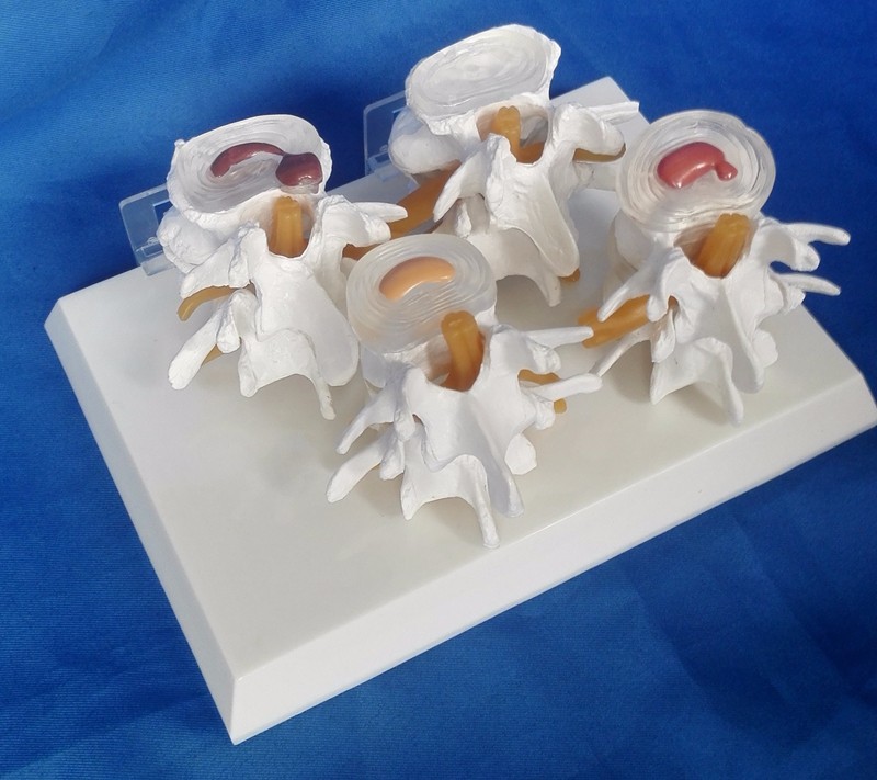 Vertebrae Diseased 4 Stage PVC Human Lumbar Spine Anatomy Model