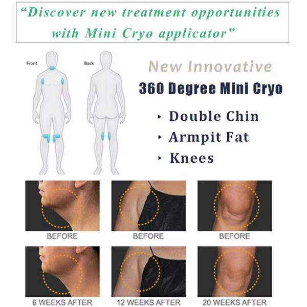 Multifunctional 360 Cryo 40K Cavitation Body Sculpting Machine With Chin And Rf Cavitation Laser