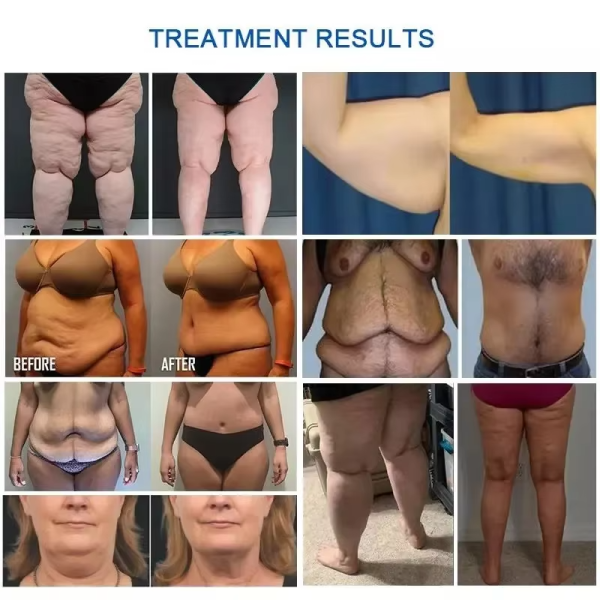 360 5MHz Cryo Fat Freezing Slimming Rf Cavitation Laser Cellulite Reduction Machine