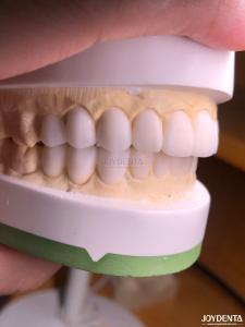 Wholesale Customized Digital Diagnostic Wax Ups for Natural Tooth Anatomy Replication from china suppliers