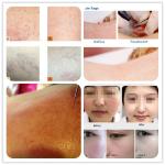 Chinese beauty equipment exporter laser varicose vein removal machine