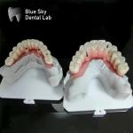 Blue Sky Implant Full Arch Implant Cases Nature Implantation Cases