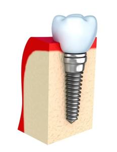 Wholesale Dentures Temporary Dental Implant Bar Single All Ceramic Teeth from china suppliers