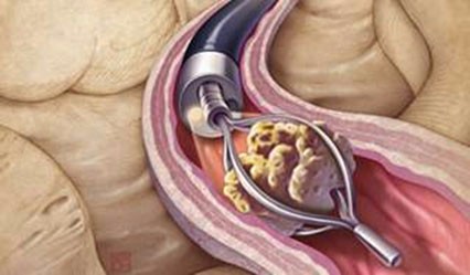 Gastrointestinal Tract Stone Retrieval Basket Endoscope Nitinol Stone Extractor