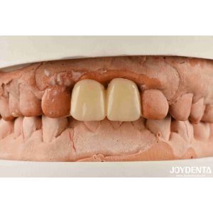 Multilayer PMMA Polymethyl Methacrylate For Dental Restorations