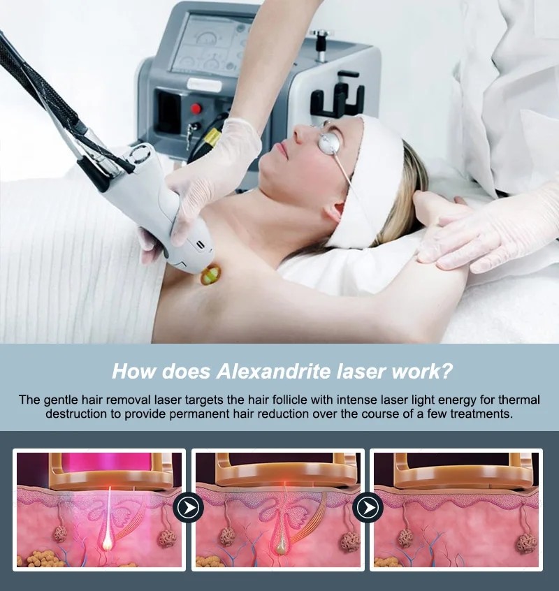 1064nm Long Pulse Nd Yag Laser Machine Vascular Removal Permanent Hair Removal