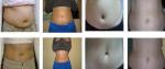 Hot Promotion!!! Three Cryo applicators Coolsculpting Cryolipolysis cavitation