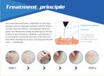 CE approved effective red facial veins removal machine for beauty salon or home