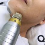 Touch Screen Microneedling Fractional RF Skin Rejuvenation 0.2MM Needle