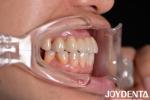 Natural Color Multilayer Dental Zirconia Bridges For Optimal Patient Experience