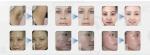SHR super hair removal machine shr elight ipl machine for skin rejuvenation