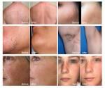 Factory Price Vertical Soprano Titanium Diode Laser Painless Hair Removal Beauty