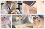 Surgical Fractional Co2 Laser Yag Laser Carbon Acne Scar Removal Wrinkle