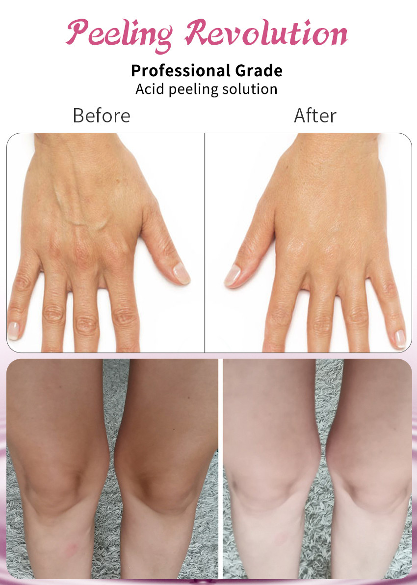 High-Quality Skin Peeling Serum Promotes Collagen Regeneration And Lifts The Skin