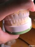 Customized Digital Diagnostic Wax Ups for Natural Tooth Anatomy Replication