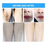 Permanent Ice 1064nm Hair Removal Beauty Machine Triple Wavelengths Diode Laser