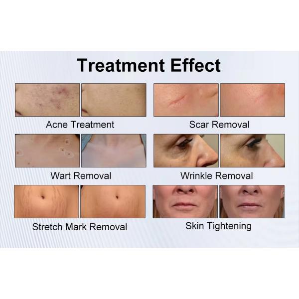 40W Glass Tube 10600nm Fractional Co2 Laser For Acne Removal Scar Remove Treatment