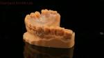 Perfect Fit Germany Ortho Teeth Halley Retainer for Esthetics and Adjustability