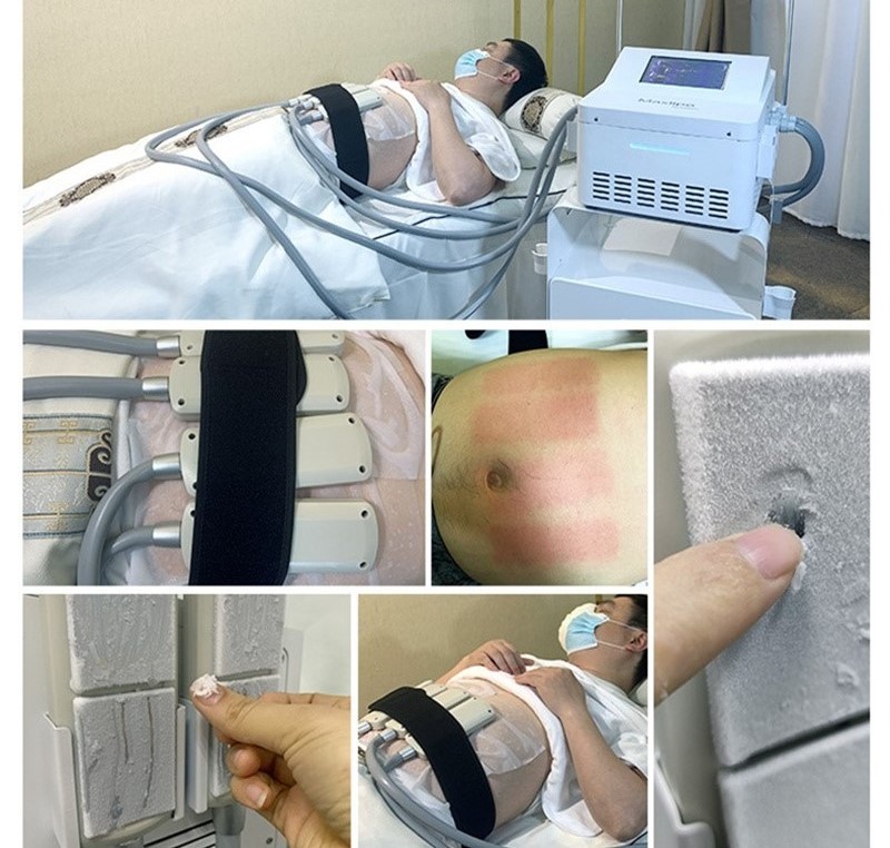 Ems Fat Reduce Cryo Plate Machine With 4 Cooling Pads