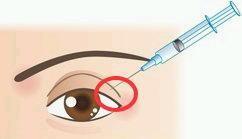 Wholesale Non Cross Linked Medical Ophthalmic Sodium Hyaluronate Gel hyaluronic acid filler For Intr from china suppliers