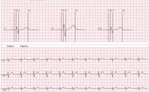 Wholesale Wecardio 3-Leads Cardiac Event Recorder Bluetooth ECG Monitor Mobile EKG Telemetry HRV from china suppliers
