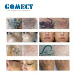 Picosure Laser Tattoo Removal Machine , Q Switched Laser Machine For Pigmentatio