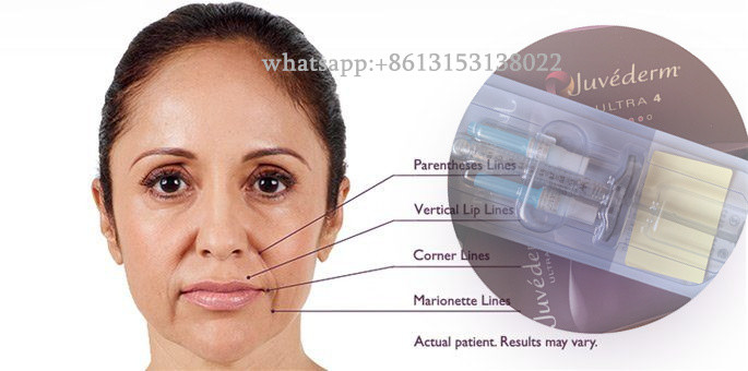 Juvederm Hyaluronic Acid Facial Filler Long Lasting Ultra3 Ultra4 Voluma Injection
