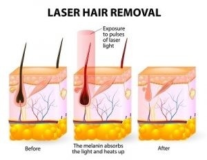 Permanent Hair Removal Diode Laser Machine 1200W For All Skin Types