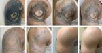 CE TUV Q Switched ND Yag Laser Tattoo Removal Machine Non ablative