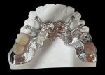 Customizable Cast Partial Removable Denture With Acrylic Resin / Metal Base