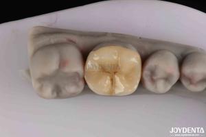 Wholesale Customizable Zirconia Inlay Onlay Minimal Preparation For Damaged Teeth Restoration from china suppliers
