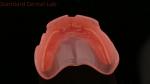 Complete Denture Ivoclar Full Denture Acrylic Teeth SDL Dental Lab