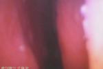 Video Ear And Nose C amera Digital Otoscope For Perforation Of The Tympanic