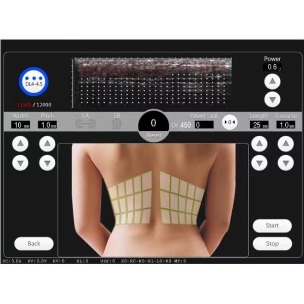 Clinical Use High Intensity Focused Ultrasound Machine Skin Elasticity Improving